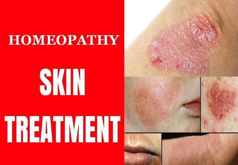 Kesula Clinic Permanent Treatment For Fungal Infection-4894