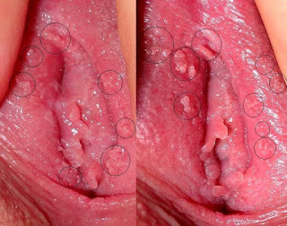 Mengapa Daging Tumbuh di Vagina Atau Memek
