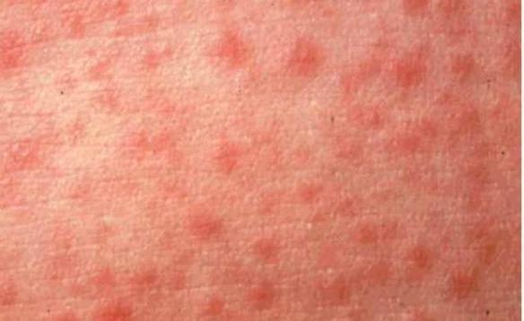 Rubella | German Measles | Home | CDC