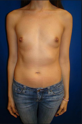 Small breast Clearance