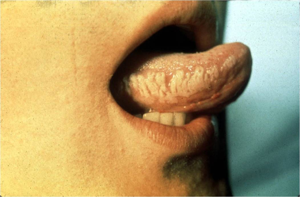 Early symptomatic HIV infection as related to Hives - Pictures