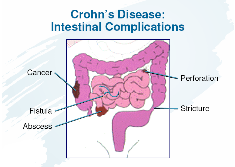 Internal Medicine IBD Management Goals of Crohn's Disease and