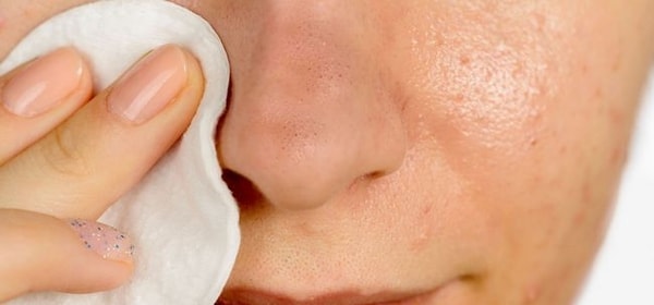 Get rid of Blackheads at Home 