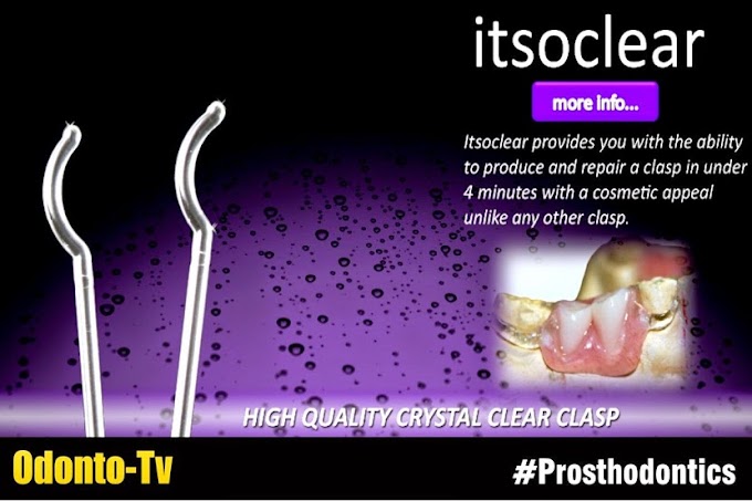 PROSTHODONTICS: Shaping Itsoclear Clasps with a Burner