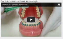 Video mostra como limpar os dentes com Aparelho Ortodôntico