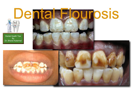 effect of flourosis on teeth health