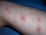 Bullseye Rash Information | Bubble Bee Business