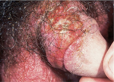 Pyoderma of the penis in a patient with scabies