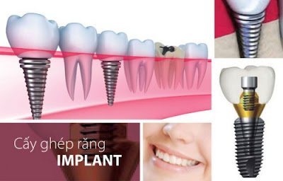 Những lý do nên thực hiện cấy ghép răng Implant