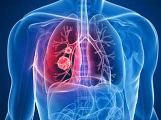 penyakit kanker paru paru