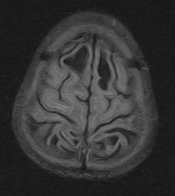 Van der knaap disease, a megalencephalic leukoencephalopathy Sumer's