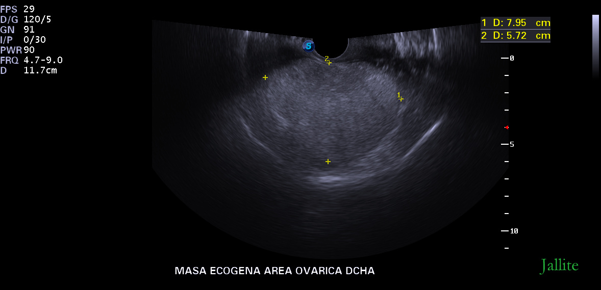 Teratoma Ovarico