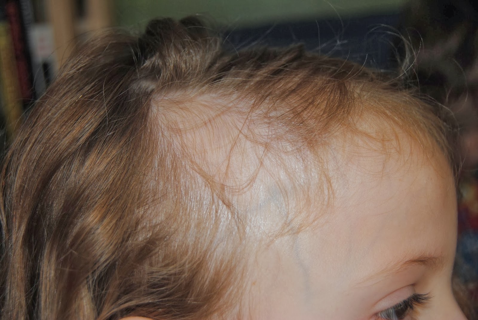 Почему плохо растут волосы на голове. Залысина на голове у ребенка. Редкие волосы у ребенка.