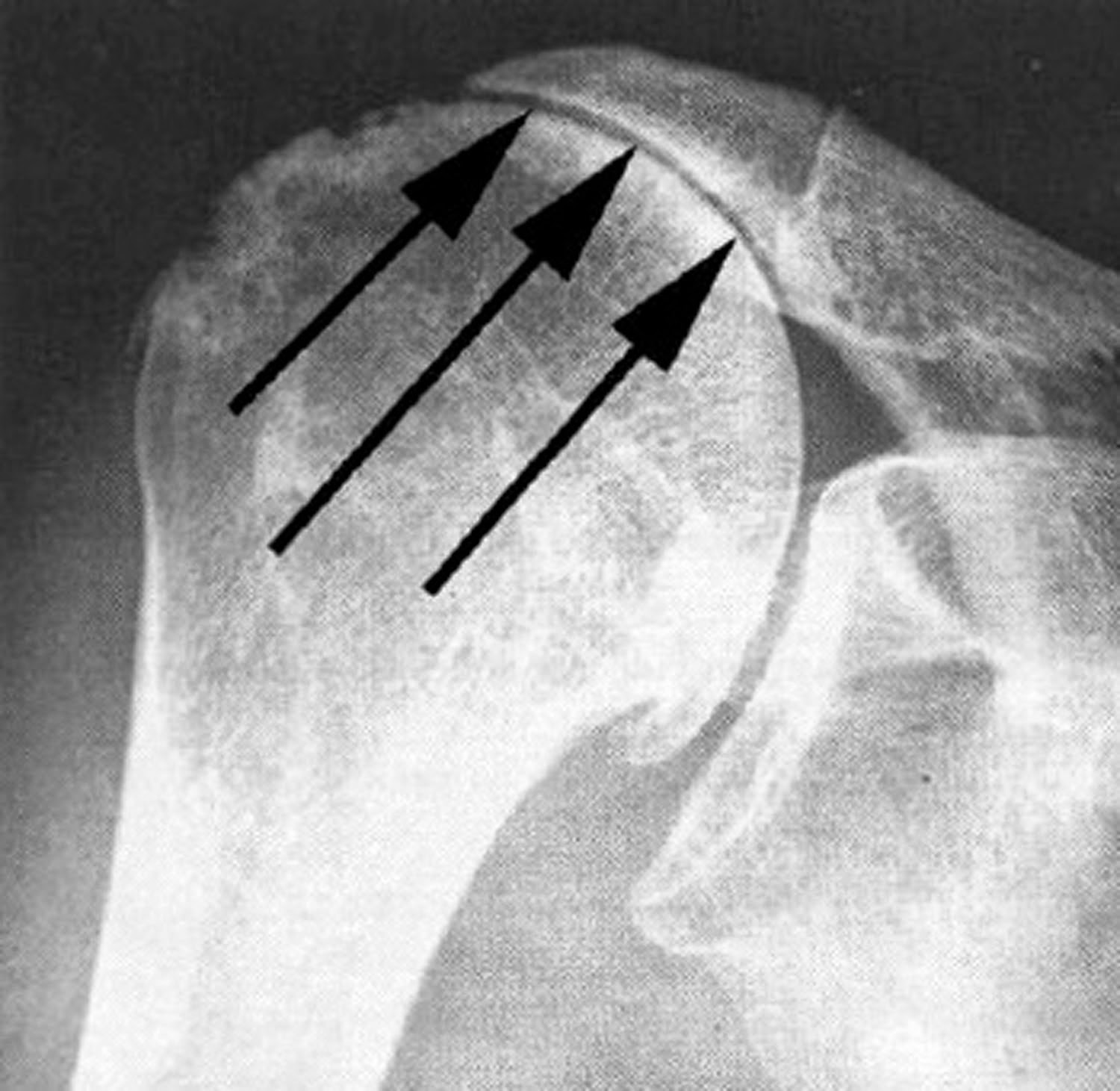 UW Shoulder and Elbow Academy The rotator cuff deficient shoulder