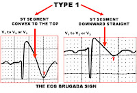 Brugada Syndrome : Relationship With Structural Heart Disease