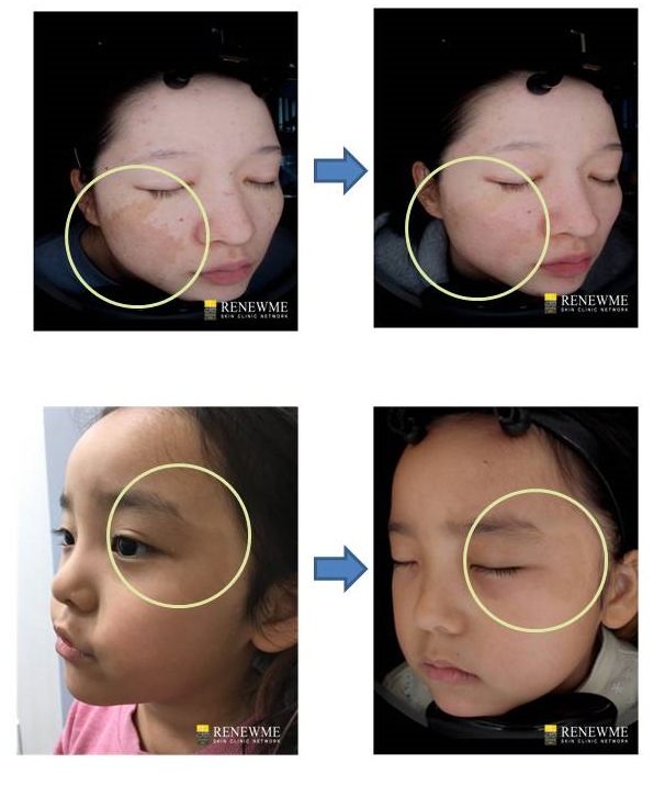 Renewme Skin Clinic Birthmark Caf Au Lait Spot Removal Laser Treatment Renewme Skin Clinic Birthmark Caf Au Lait Spot Removal Laser Treatment