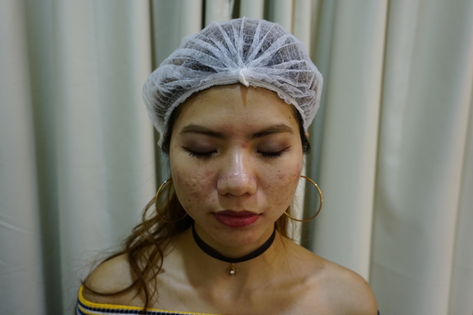 Laser for Acne Dual Yellow Laser Skin Gym SS2 J & D Learn to Blog
