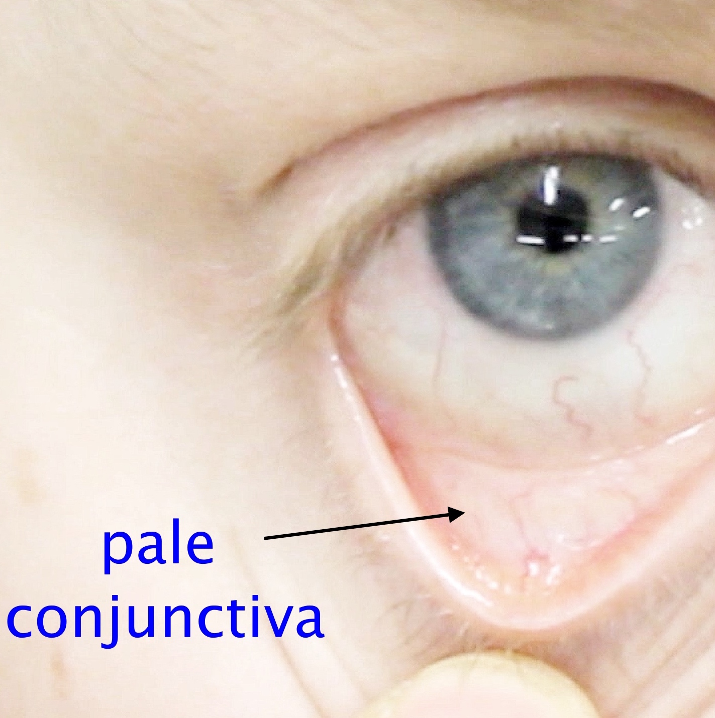 Study Medical Photos Iron Deficiency Anemia