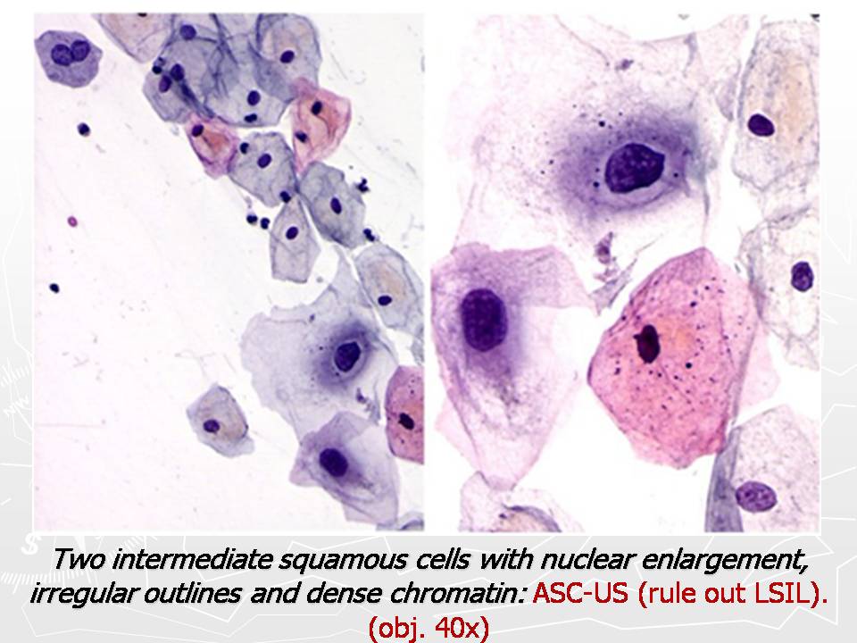 Плоский эпителий в цитограмме. Кариопикнотические клетки. Цитологическая картина LSIL. Кариопикнотические клетки в мазке.