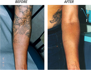 Tattoo Removal Methods  News