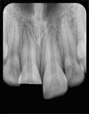 Trauma Endodontics