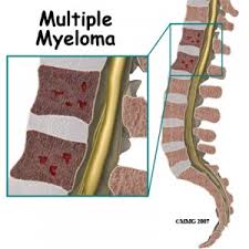 Pengobatan Tradisional Multiple Myeloma