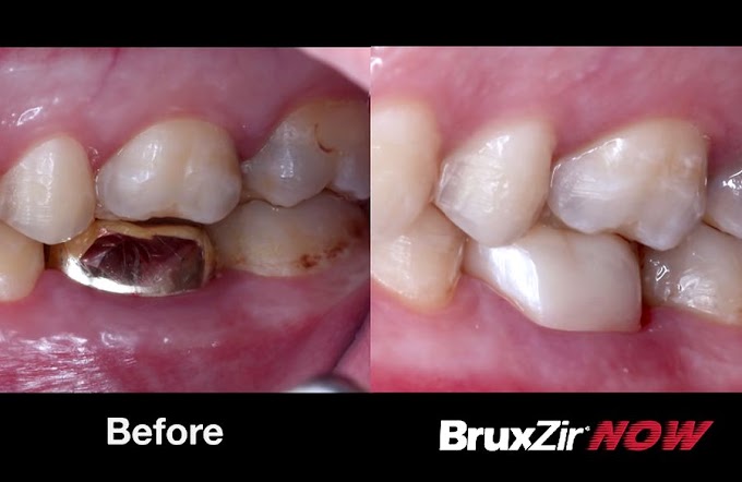 ZIRCONIA CROWN: Replacing a Gold Crown step by step