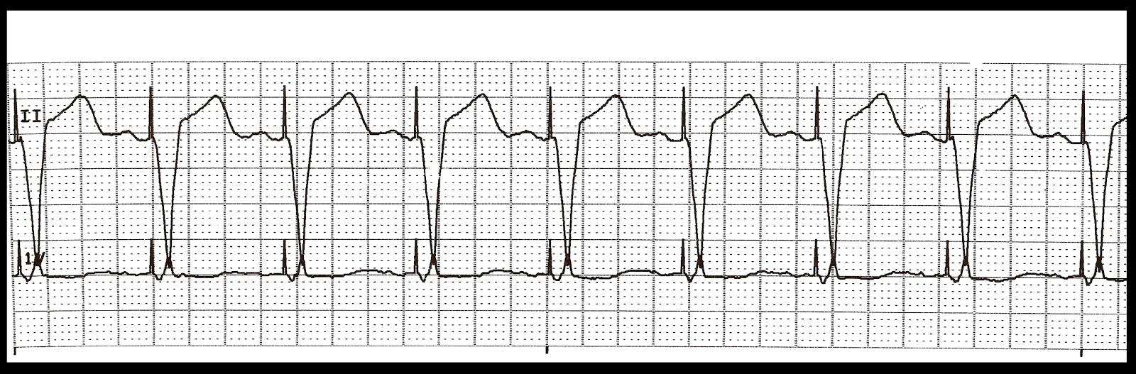 Basic EKG Rhythm Test 32