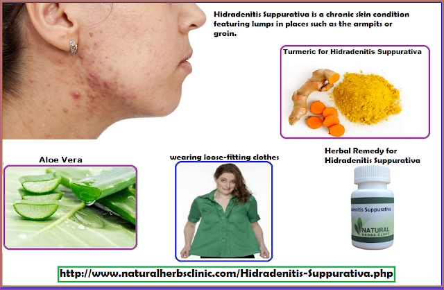 Hidradenitis Suppurativa Treatment Home Remedies