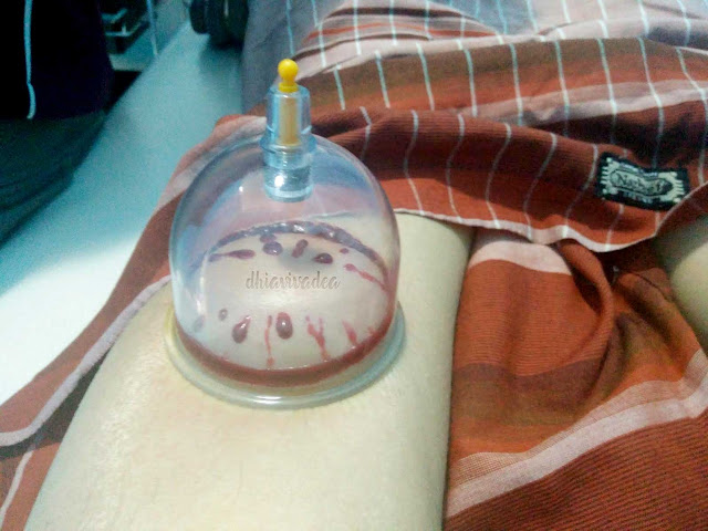 Rawatan Bekam Dr Hijama Dikendali Oleh Doktor Bertauliah 5