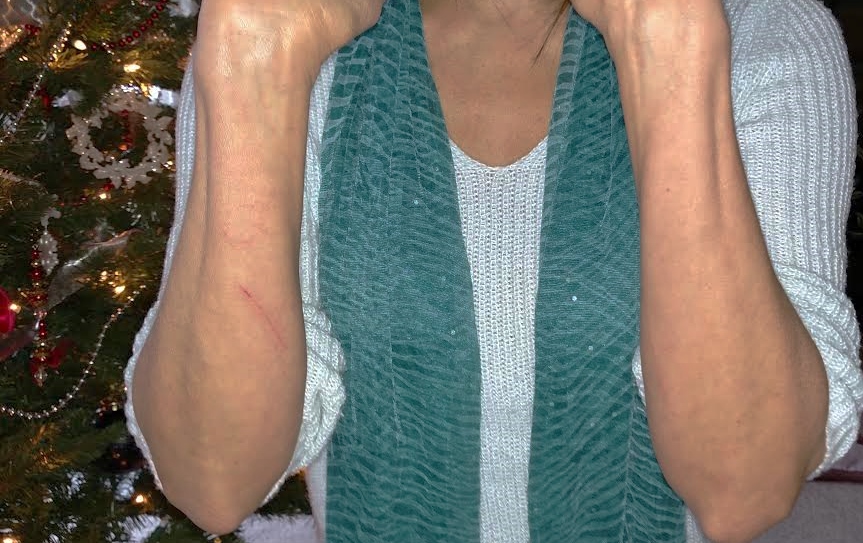 Allergy Rash from Christmas Tree Causes and Remedies