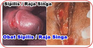 Penyakit Raja Singa