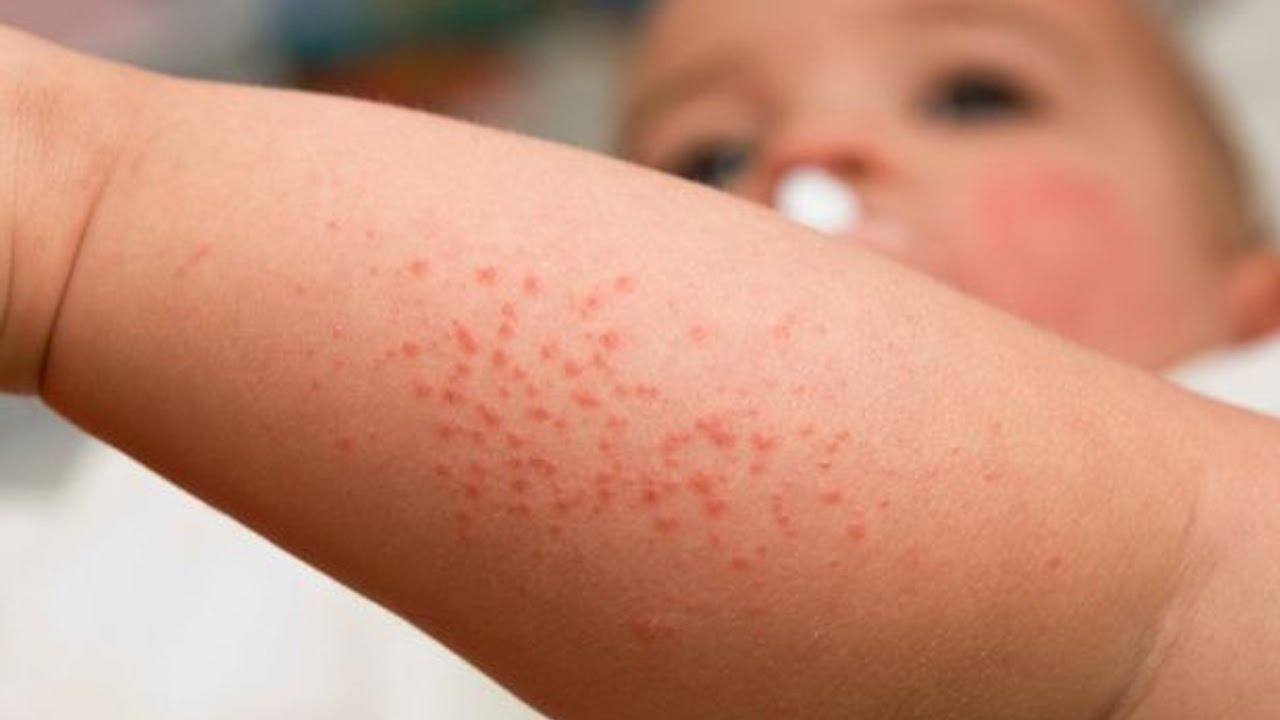 Home Remedies for Prickly Heat Rash on Babies Heat Rash Treatment for