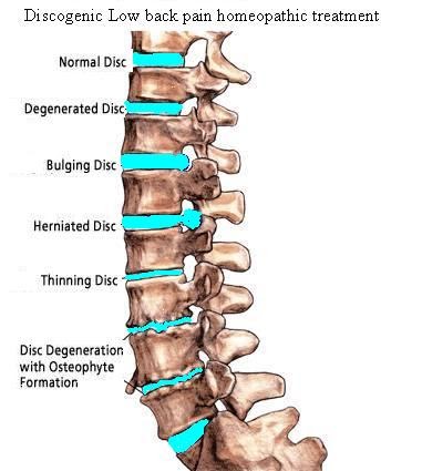 Discogenic Low Back Pain Homeopathic Treatment « Use Homeopathy And Be ...