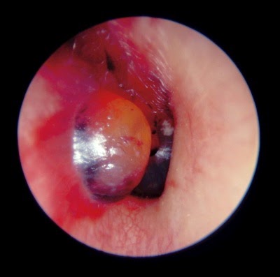 Otitis Externa Haemorrhagica