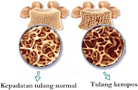 http://sayherbal.blogspot.com/2015/09/cara-mencegah-keropos-tulang-dan-sendi.html