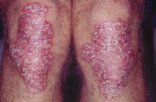 Obat Ampuh Eksim Di Kaki Yang Menahun