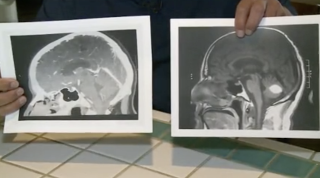 California Man Gets Second Chance At Life When Brain Tumor Vanishes Without Surgery