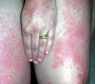 A polymorphous light eruption rash on the patient's thighs and hand pictures