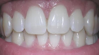  Cara memutihkan gigi kuning secara alami dan cepat