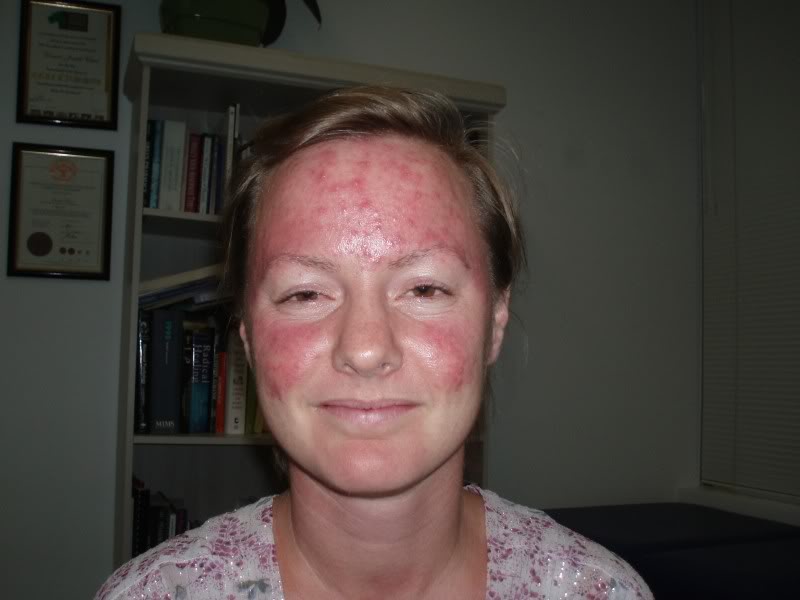 Como Curar Acne Rosacea Con 7 Remedios Caseros Rosacea Tratamiento