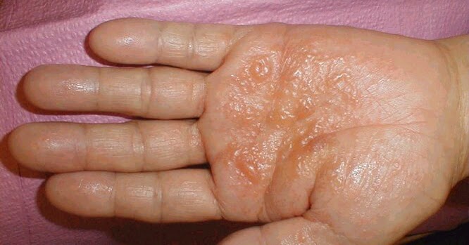 REFERENSI PENYAKIT: Penyebab dan Cara Mengatasi Bintik Air di Telapak