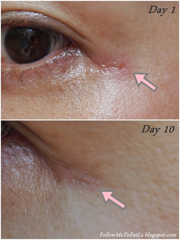 Follow Me To Eat La Malaysian Food Blog CO2 Laser for Removal of