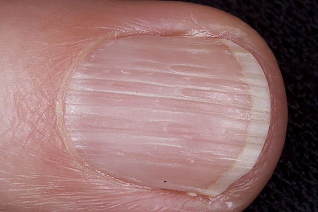 Vertical Lines On Fingernails Deficiency