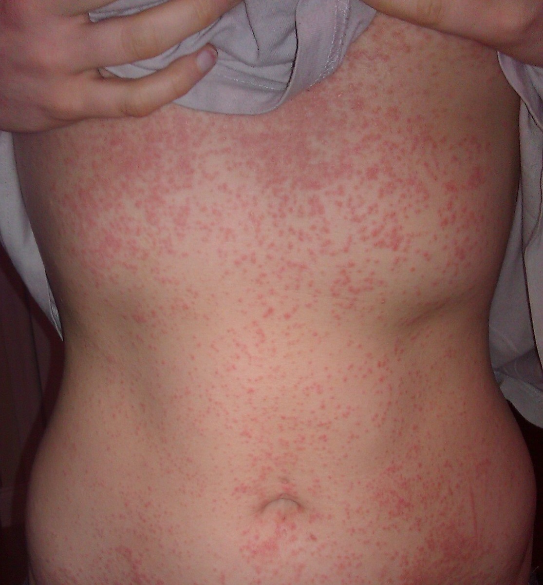 Eczema and prednisone advice.. please? - Skincell.org