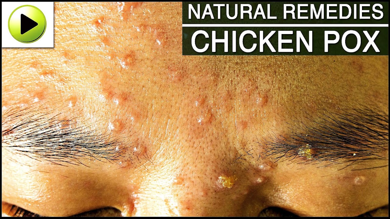 Chickenpox Chicken Pox Antibiotics Chicken Choices