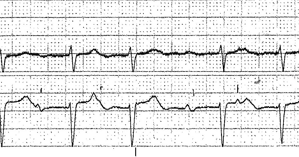 ECG Rhythms: Group-Beating: The Footprints of Wenckebach ladder diagram ekg 