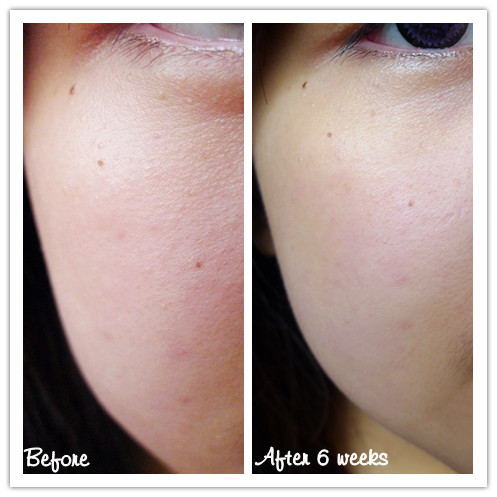 testimoni loreal white perfect