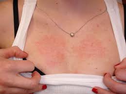 Blotchy skin rash on chest, back and neck - Dermatology ...