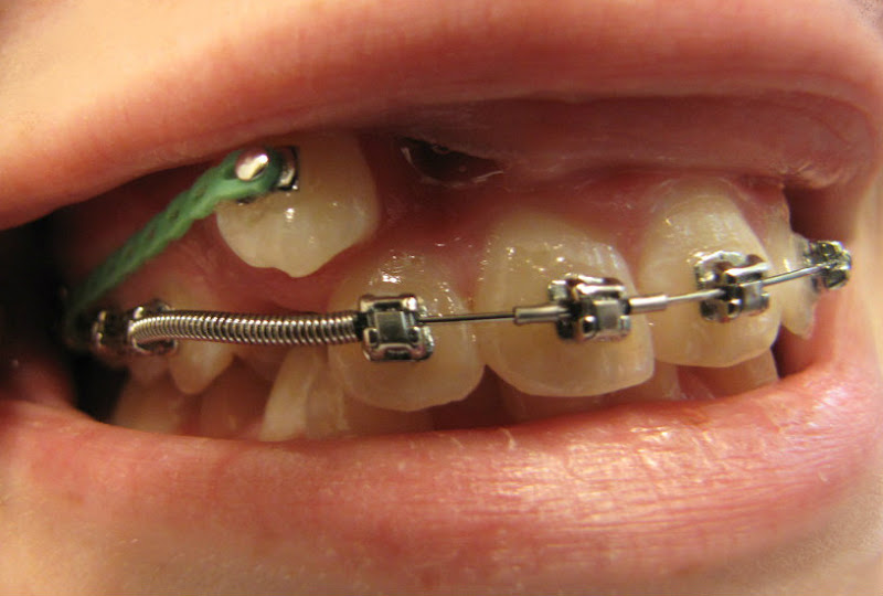 Braces With Chain To Pull Down Tooth at Zane Humphrey blog